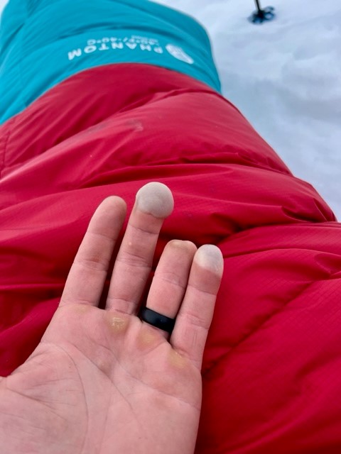 Frostbitten fingers blistered.