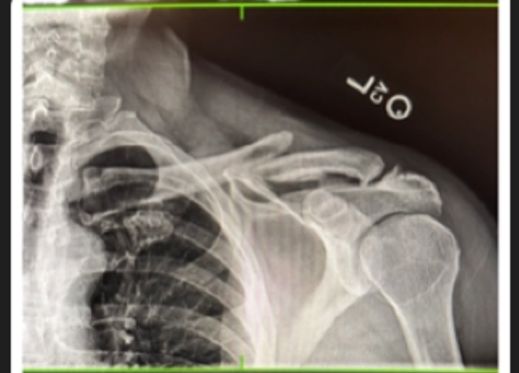 An x-ray of a broken left clavicle bone.