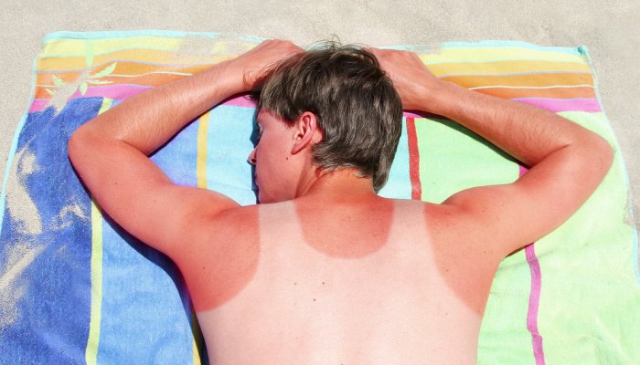 A white man with a bad sunburn on his back lies on a towel at the beach.